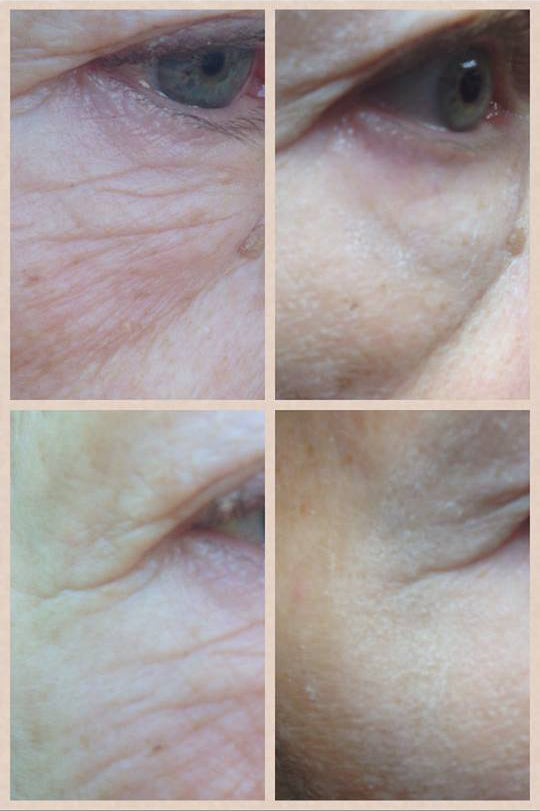 Anti-Aging Instant Erasure Serum Before & After